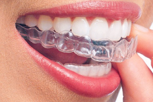 Dental Aligners